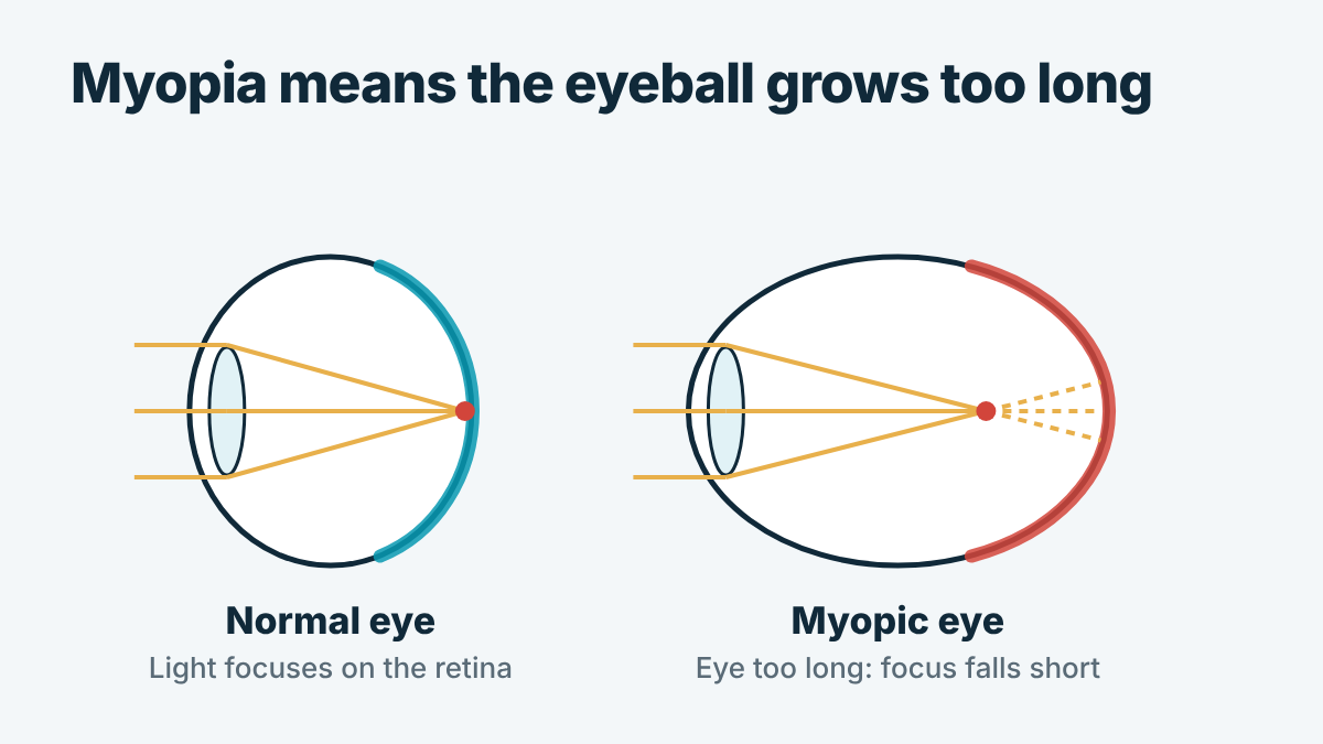 Diagram of a normal eye compared with a longer myopic eyeball